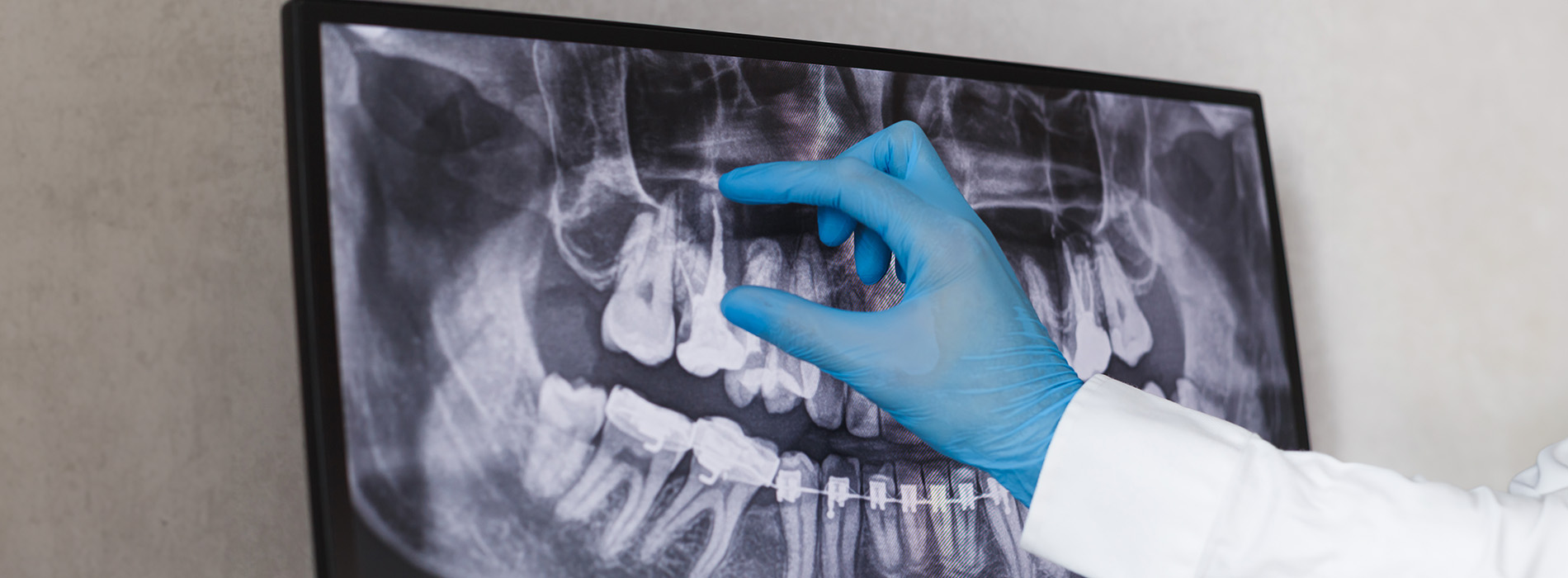 A medical professional in blue gloves points at an X-ray image on a screen with a skeletal model behind it, likely explaining the medical findings to a patient or colleague.