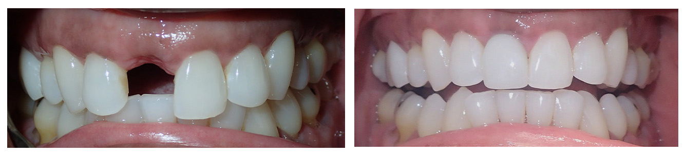 The image shows two close-up photographs of teeth with different levels of dental work, showcasing various stages of tooth restoration, likely for an educational or informational purpose related to dental care.