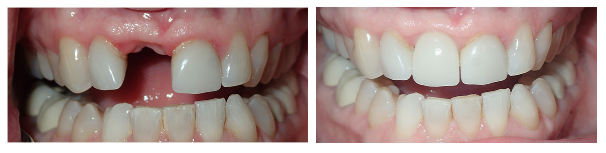 The image shows a close-up of a person s teeth with some missing, against a grey background, displaying two different views of dental implants.