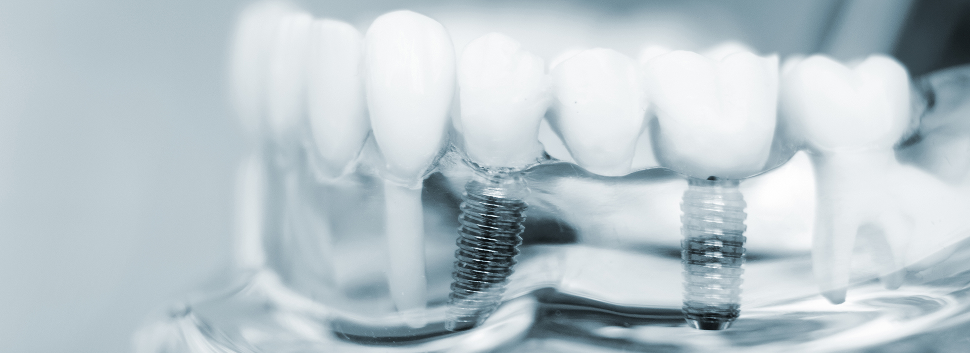The image displays a close-up view of multiple dental implants and screws against a blurred background.