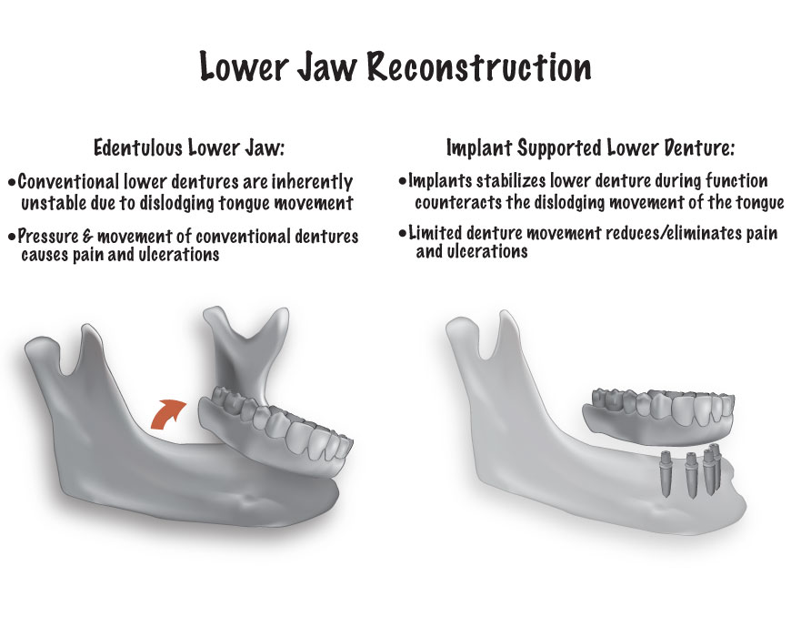 Dental Implants Lower Jaw Reconstruction Northern Star