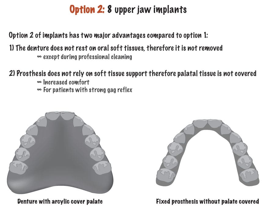 Dental Implants Upper Jaw Reconstruction Northern Star